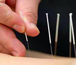 Akupunktura lecznicza